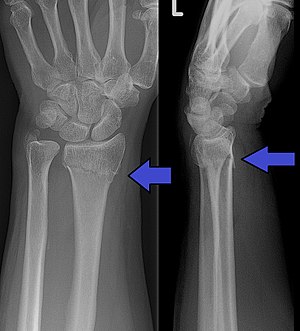 Distal Radius Fracture x-ray