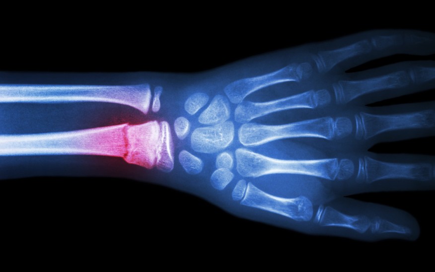 Distal radius fracture x-ray