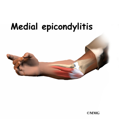 Medial Epicondylitis anatomical view