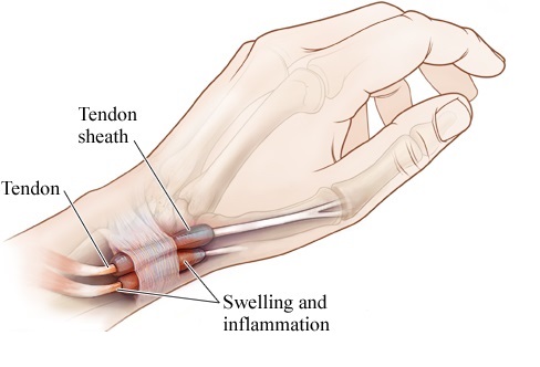 Anatomical Image of APL/EPB De Quervains Tendonitis